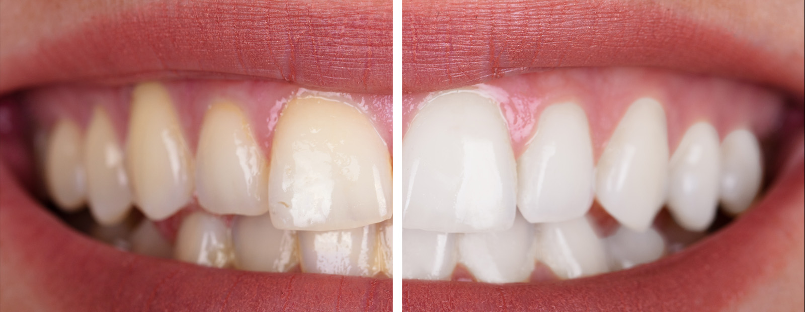 Nach zahn wurzelbehandlung sich grau verfärbt Toter Zahn