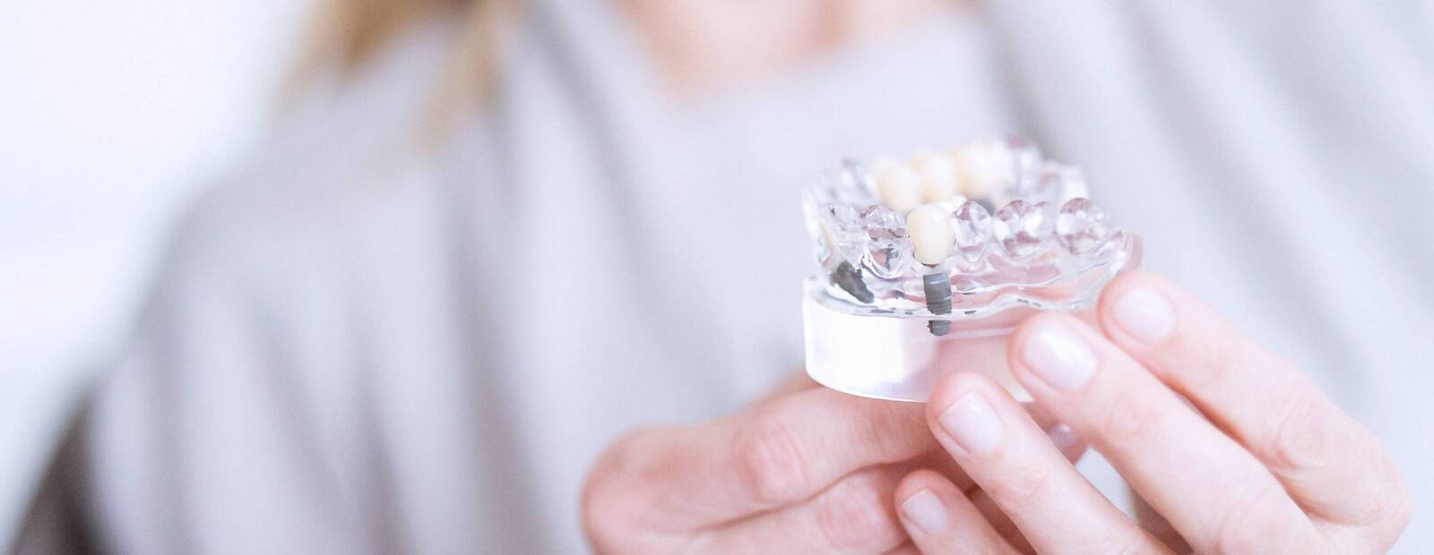 Zwei Hände halten ein Model von Zahnimplantaten zur Anschauung